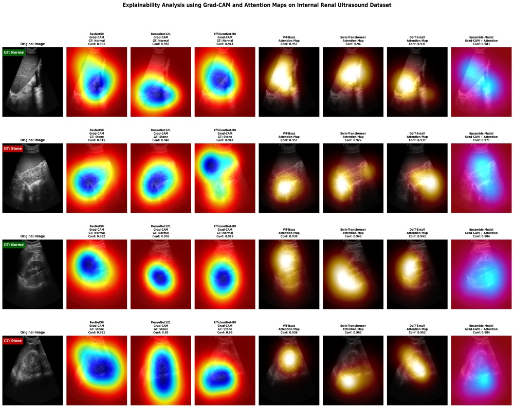 Multi-Phase CNN-ViT-Wavelet Fusion with Attention for Robust Kidney Stone Detection from Ultrasound Images